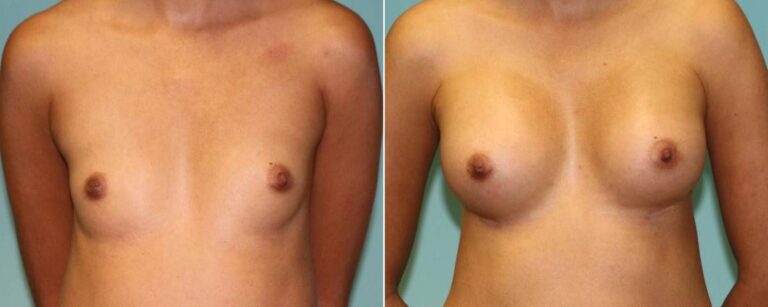 before and after breast augmentation front view case 1006
