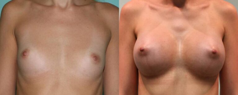 before and after breast augmentation front view female patient case 1923