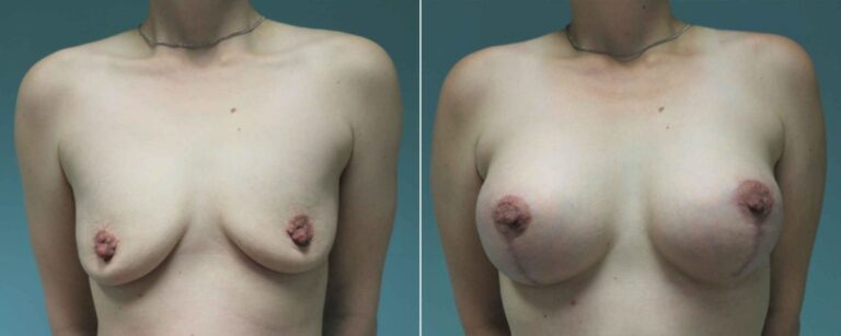 before and after breast lift front view female patient case 1279